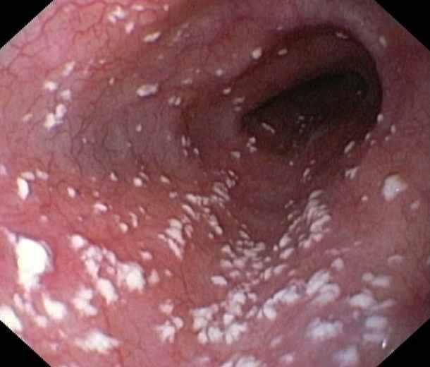 Candida overgrowth in the digestive tract