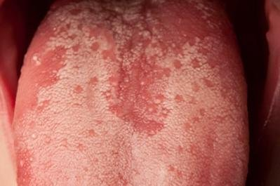 tongue coated with candida
